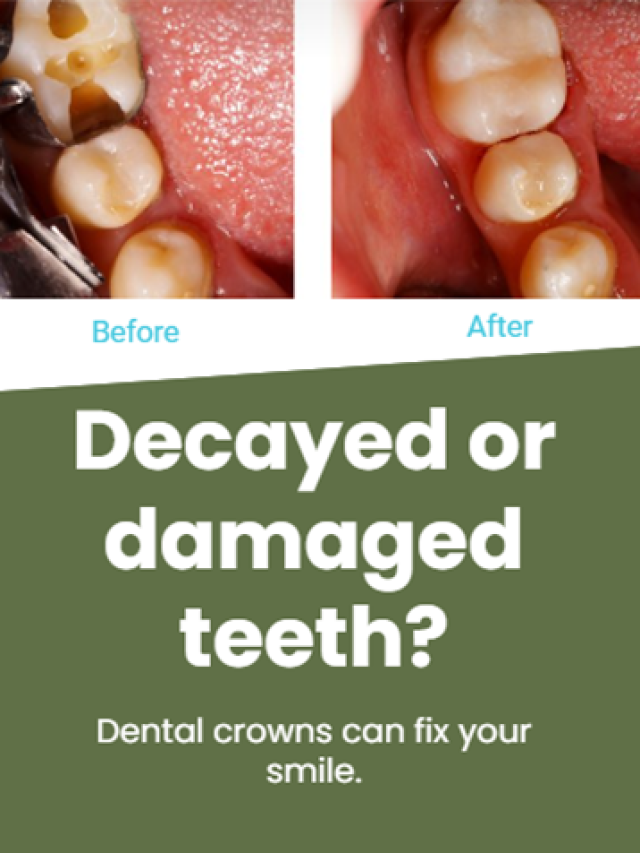 Decayed or damaged teeth?