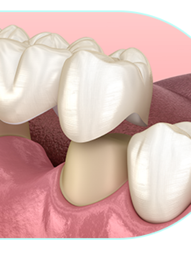 What’s the difference between a dental crown and a dental bridge?