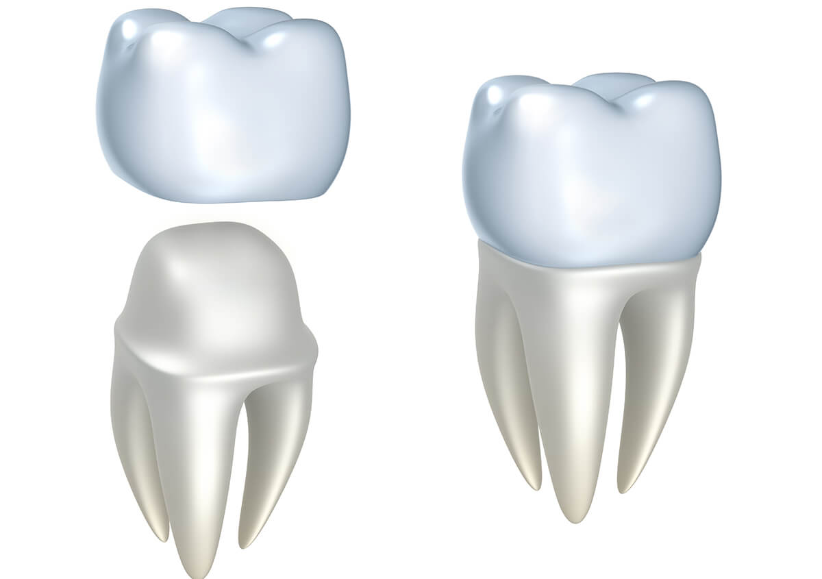 Teeth Crowns Services in Glenview IL Area