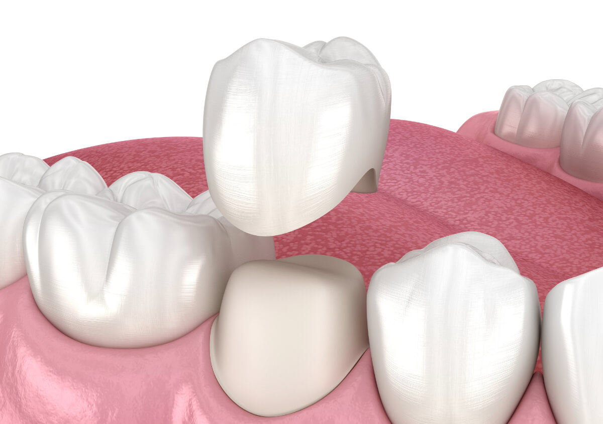 Dental Crowns for Teeth in Glenview IL area